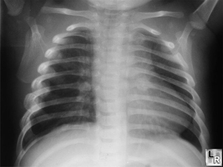 Non-accidental injury (classic metaphyseal lesion)
