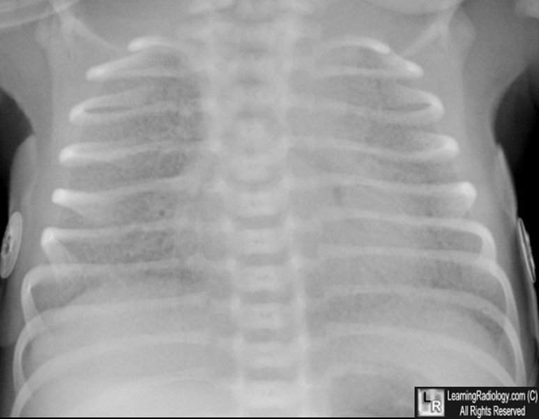 Hyaline membrane disease (neonatal RDS)