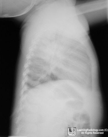 Round pneumonia